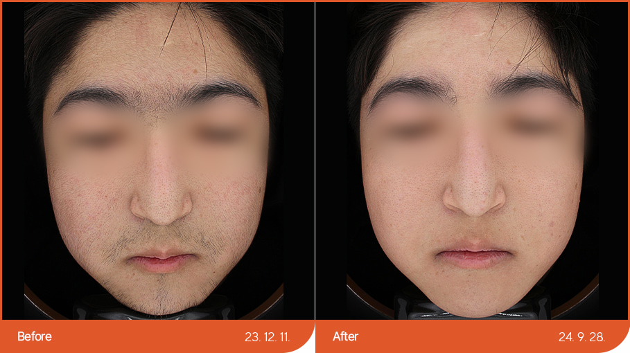 Laser hair removal 01