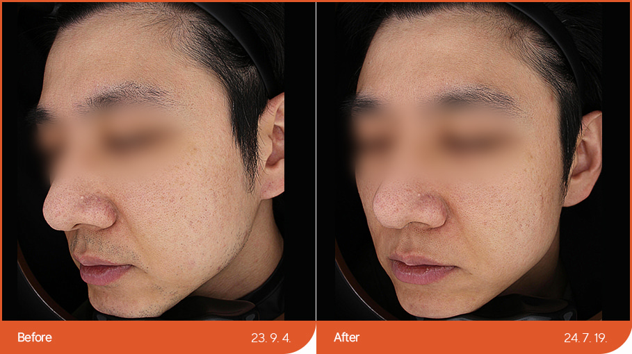 Laser hair removal 02