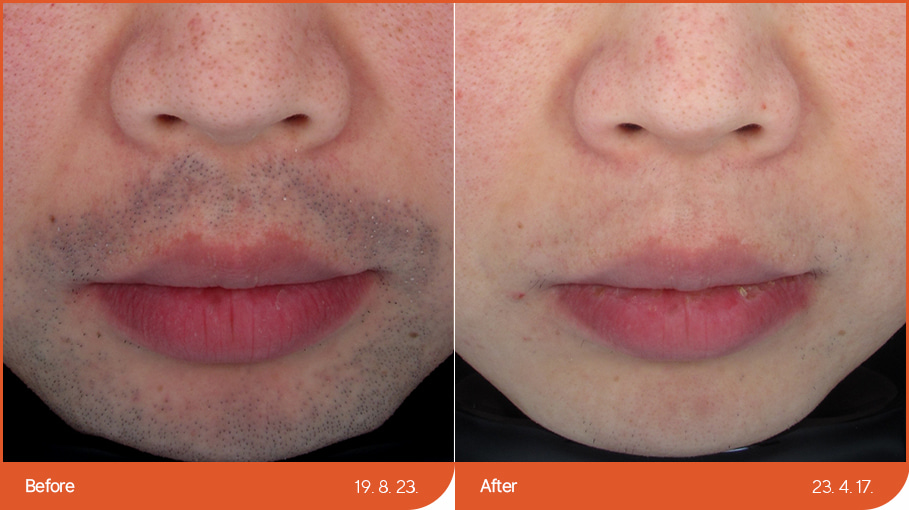 Laser hair removal 03